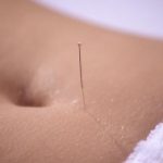 fertility acupuncture